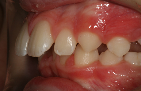 Reigate Orthodontics - Growth Modification Before - Side
