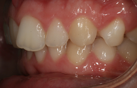 Reigate Orthodontics - Crowding Before - Side
