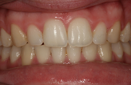 Reigate Orthodontics - Crowding After - Front