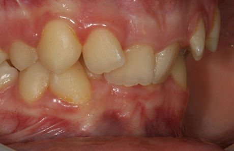 Reigate Orthodontics - Crowding Braces Before - Side