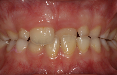 Reigate Orthodontics - Removable Braces Before - Front