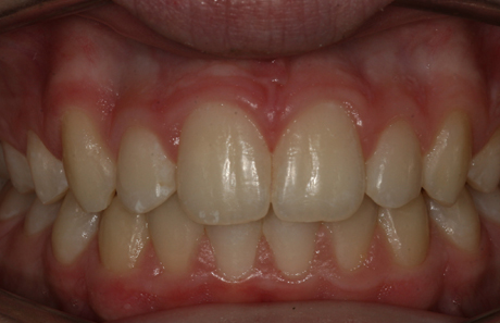 Reigate Orthodontics - Growth Modification After - Front