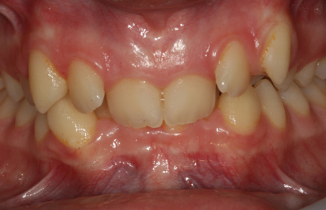 Reigate Orthodontics - Crowding Before - Front
