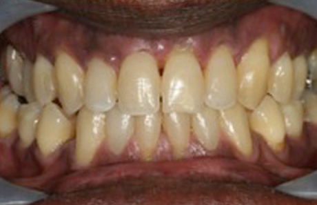 Reigate Orthodontics - Adult Braces After - Front