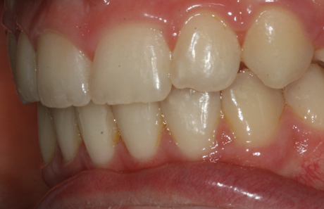 Reigate Orthodontics - Crowding Braces After - Side