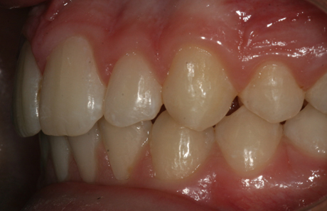 Reigate Orthodontics - Growth Modification After - Side