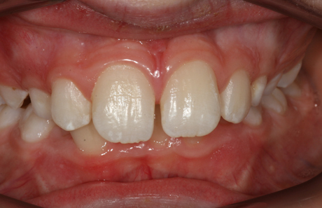 Reigate Orthodontics - Growth Modification Before - Front
