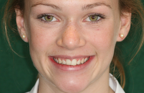 Crooked Teeth to straight teeth from Reigate Orthodontics