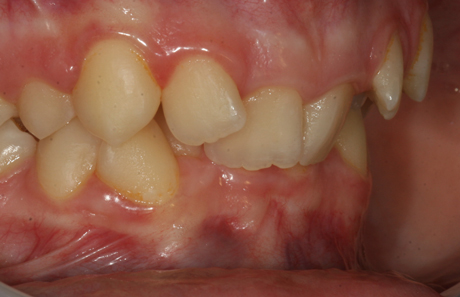 Reigate Orthodontics - Crowding Before - Side