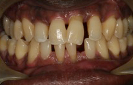 Reigate Orthodontics - Adult Braces Before - Front
