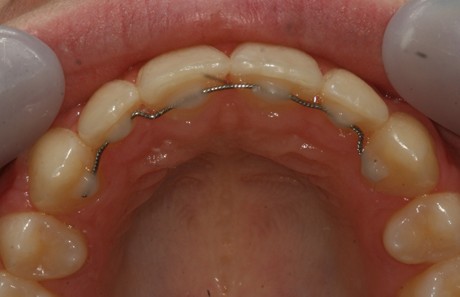 Reigate Orthodontics - Crowding Braces After - Inner