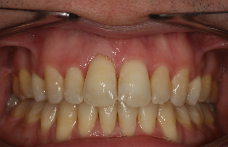 Reigate Orthodontics - Adult Braces After - Front