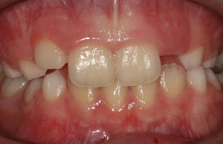 Reigate Orthodontics - Removable Braces After - Front