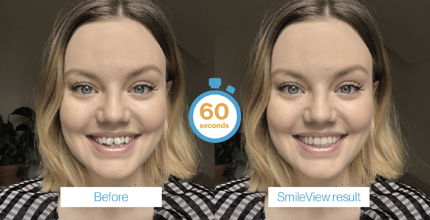 SmileView Experience invisalign