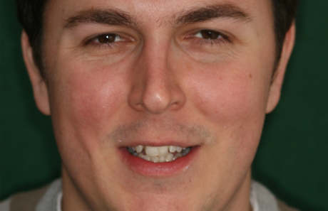 Reigate Orthodontics - Adult Braces Before - Front