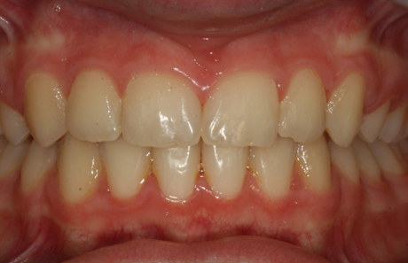 Reigate Orthodontics - Crowding Braces After -  Front