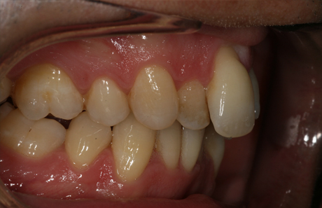 Reigate Orthodontics - Adult Braces Before - Side
