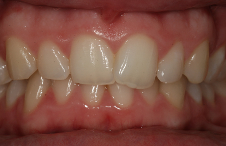 Reigate Orthodontics - Crowding Before - Front