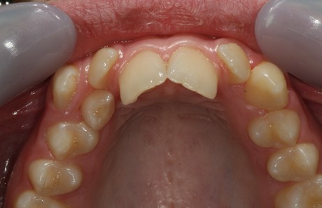 Reigate Orthodontics - Crowding Braces Before - Inner