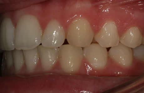 Reigate Orthodontics - Crowding After - Side
