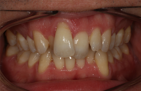 Reigate Orthodontics - Adult Braces Before - Front