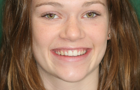 Crooked Teeth to straight teeth from Reigate Orthodontics